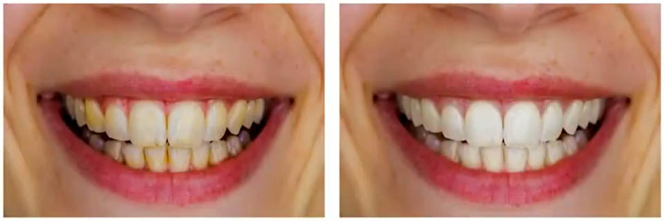 Teeth Whitening - Creating Smiles Dental - Clearwater & St. Petersburg FL