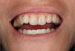 Dental Implants in Clearwtaer & St. Petersburg - Creating Smiles Dental