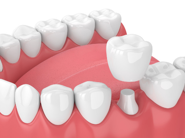 Dental Crowns in St. Petersburg FL