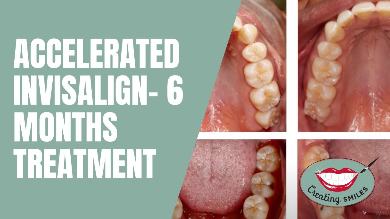 Daytime Show: Accelerated Invisalign- 6 Months Treatment
