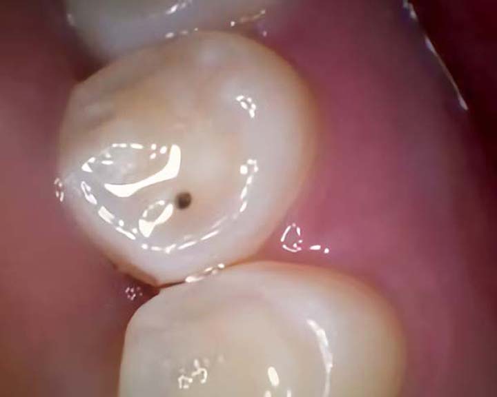 Intraoral Camera for Precise Dental Imaging