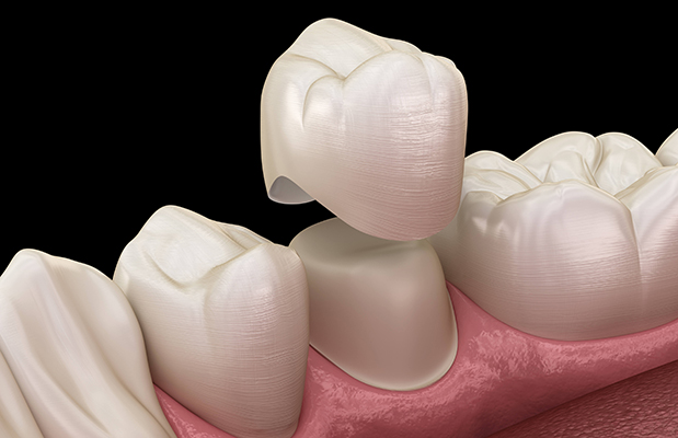 Dental crown procedure illustration showing tooth restoration on gum model with ceramic crown placement.