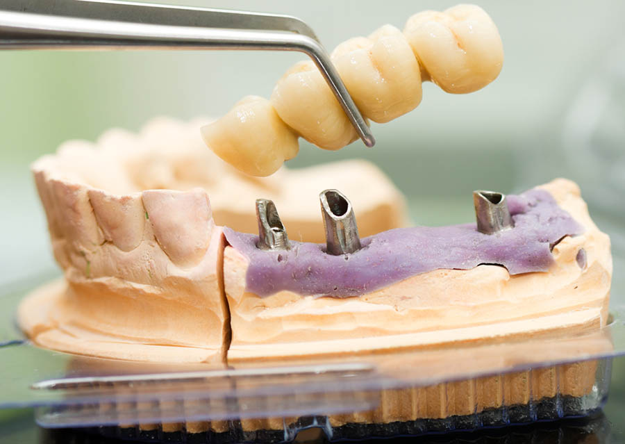 dental bridges St. Petersburg, FL