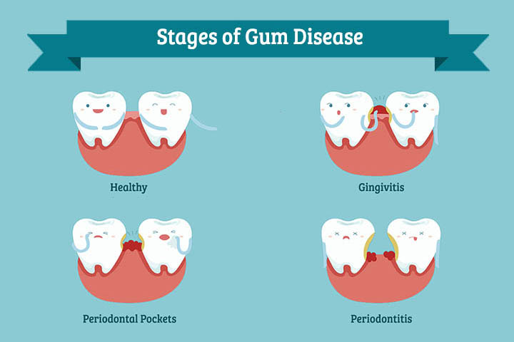 stages of gum disease