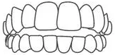 Dental illustration showing upper and lower teeth alignment and bite positioning for orthodontic reference.
