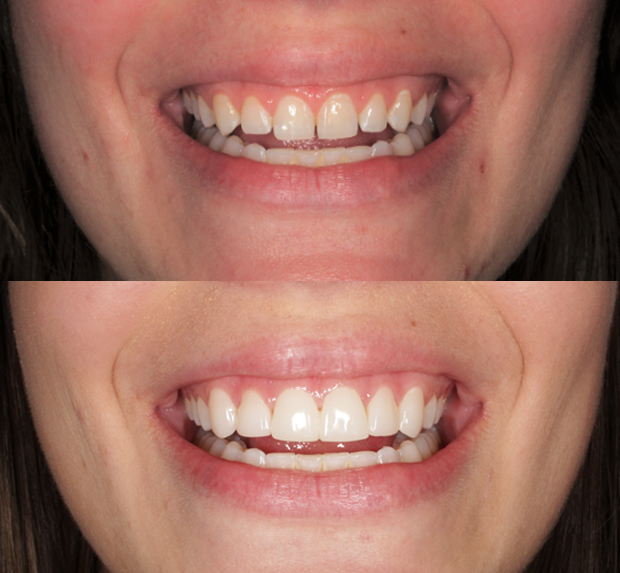 cosmetic dentistry result before after