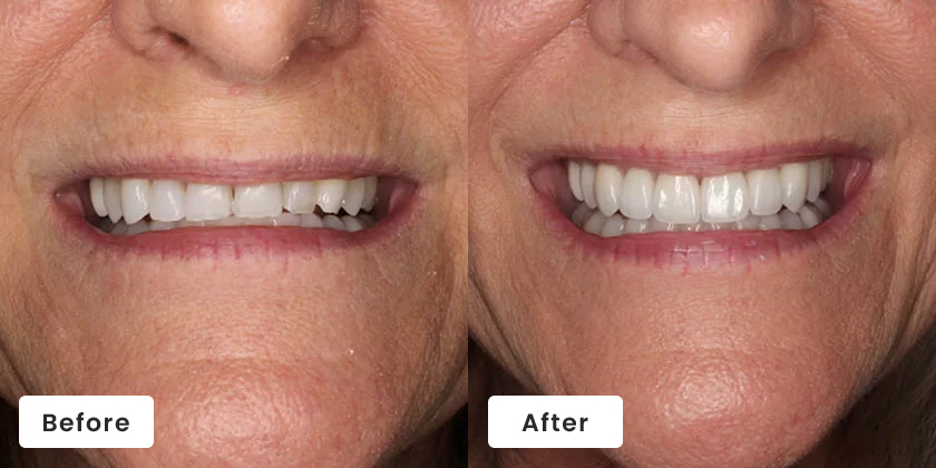 Before and after dental comparison showing improved smile brightness and tooth whiteness from cosmetic dental treatment.