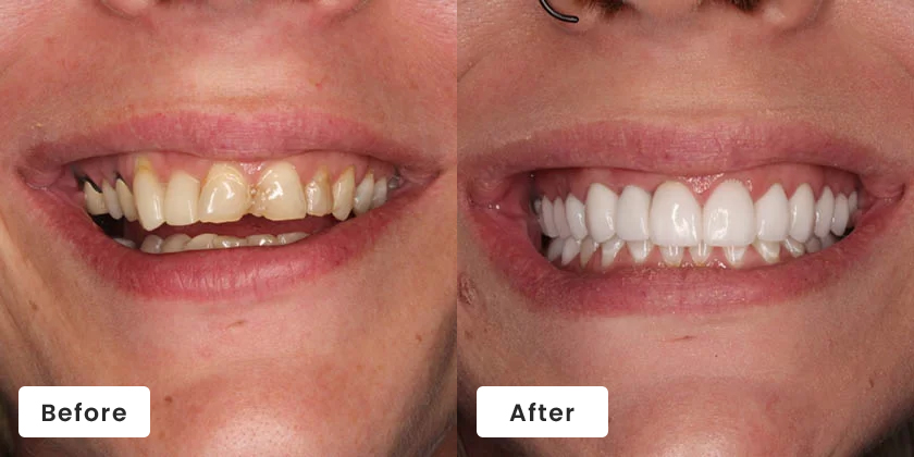 Before and after dental smile transformation showing improved tooth whiteness and alignment from Creating Smiles Dental.