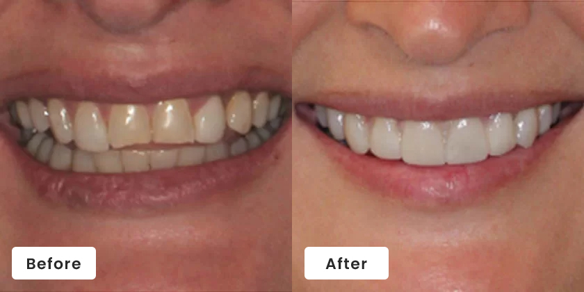 Before and after dental transformation showing improved tooth whiteness and alignment from professional dental treatment.