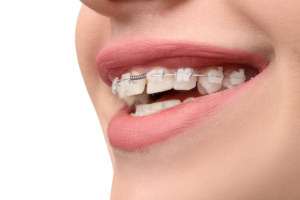 Braces