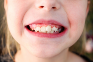 Crowded or Crooked Teeth